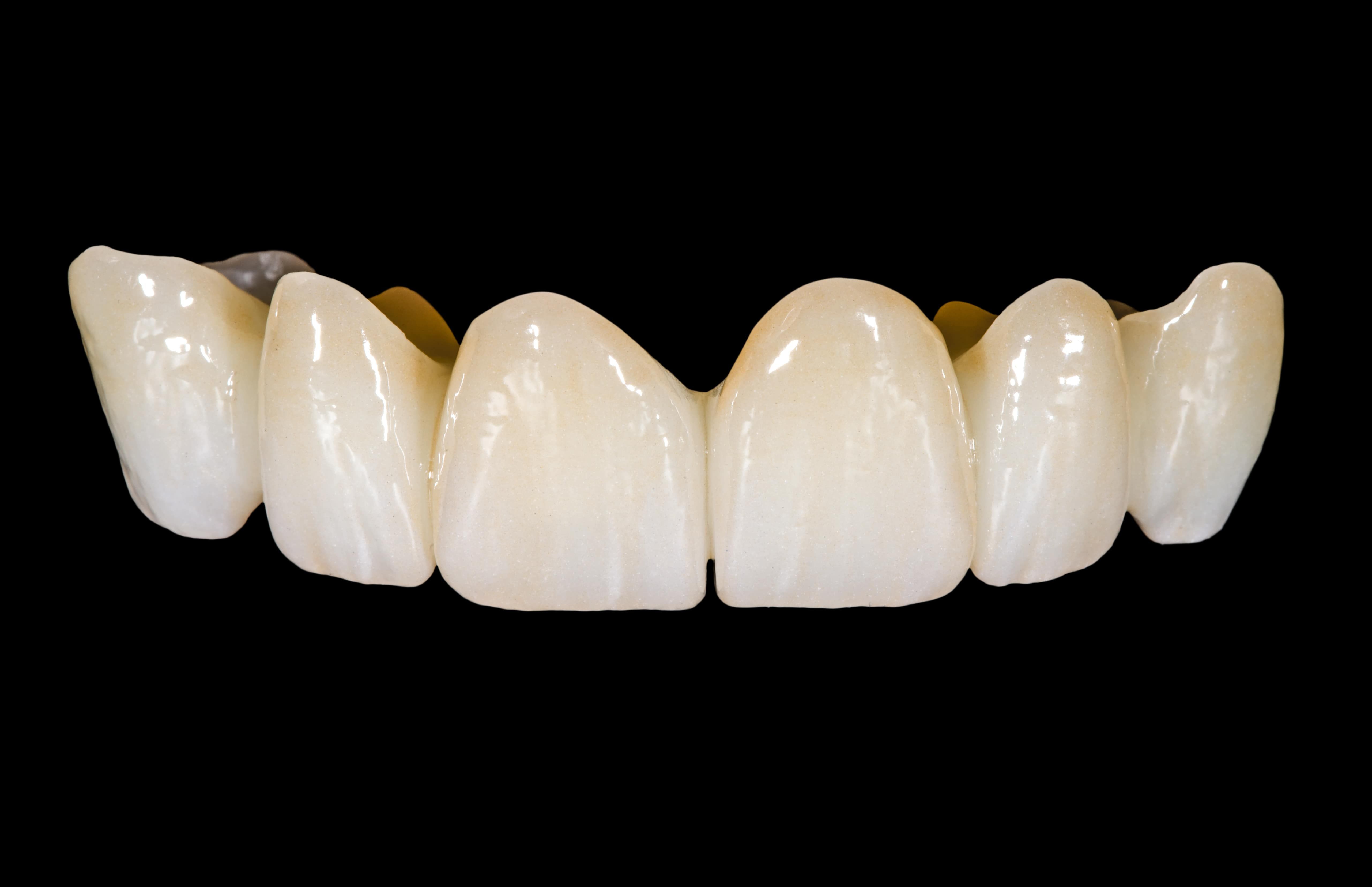 What is a Zirconia Crown? - Arc Dental