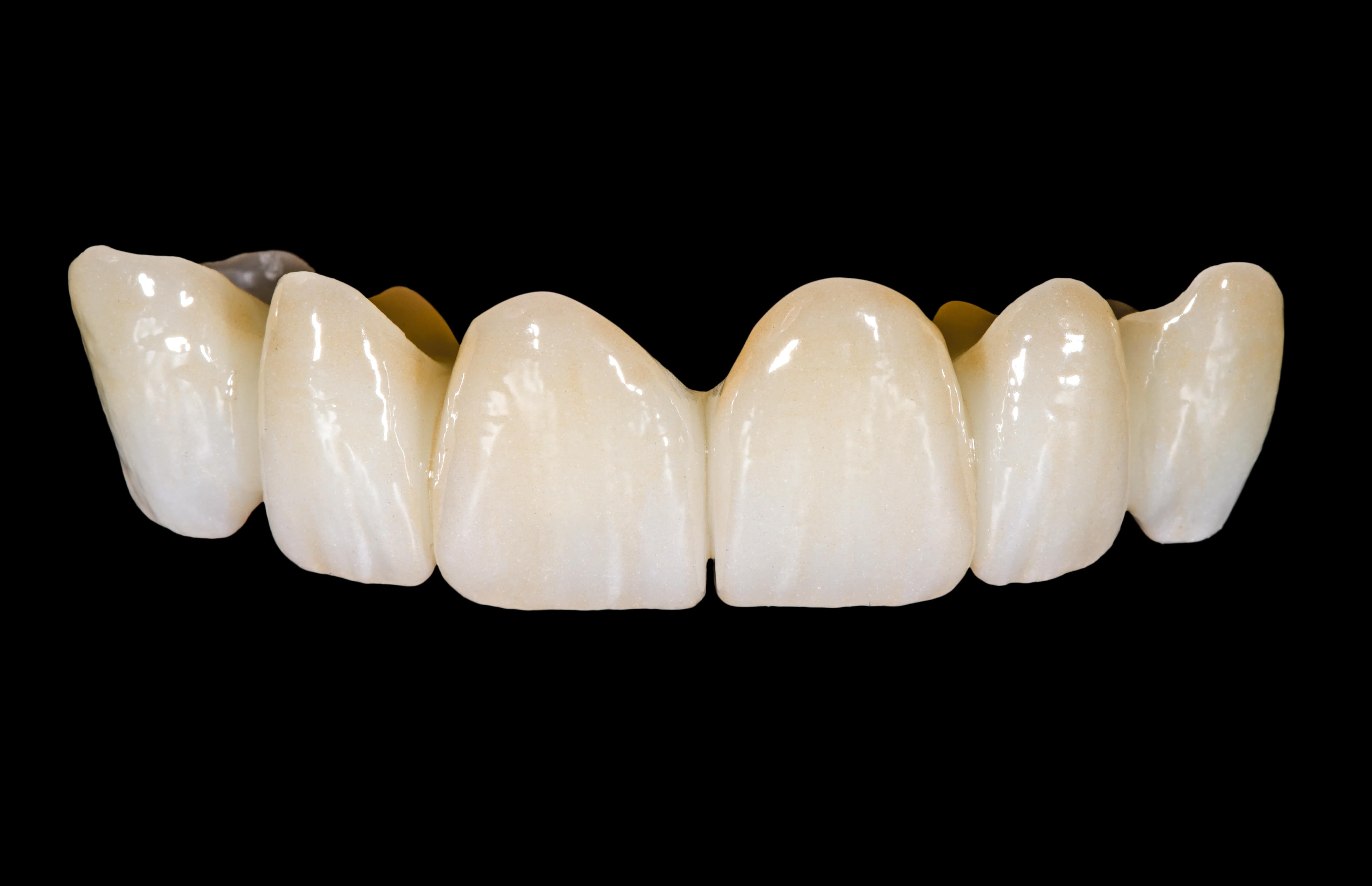 What Is A Zirconia Crown Arc Dental